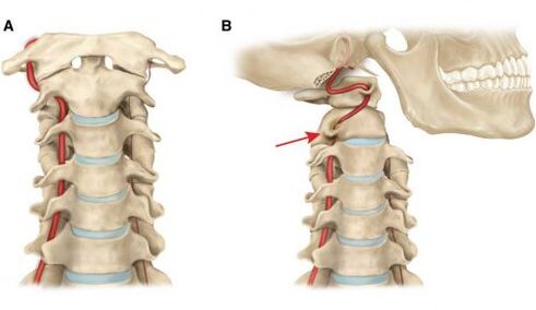 vertebral artery syndrome na may servikal osteochondrosis