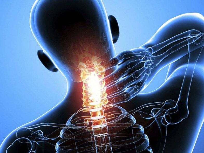 Ang Osteochondrosis ng cervical spine ay sinamahan ng sakit sa leeg