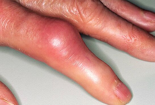 Ang gout ay sinamahan ng matinding sakit sa mga daliri at pamamaga ng mga kasukasuan. 