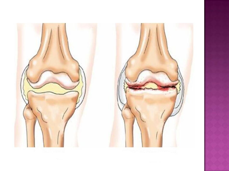 Ang kasukasuan ay normal (kaliwa) at apektado ng osteoarthritis (kanan)