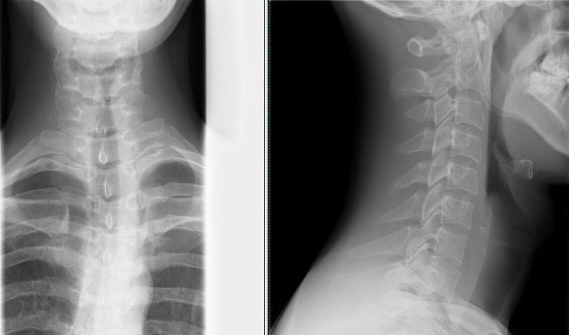 Ang X-ray ng gulugod ay isang simple at epektibong paraan para sa pag-diagnose ng osteochondrosis