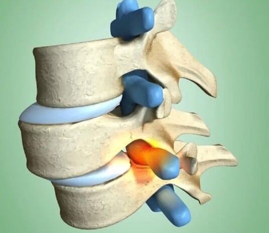 Ang hindi matatag na posisyon ng vertebra