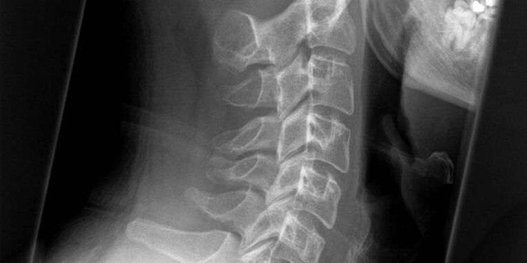 Isang larawan ng rehiyon ng cervical