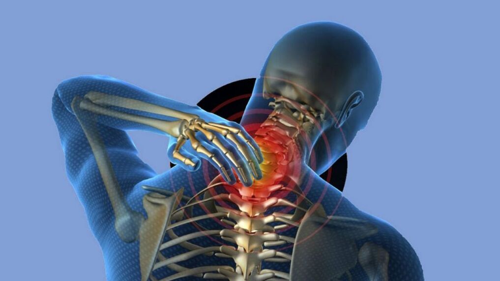 Osteochondrosis ng rehiyon ng cervical