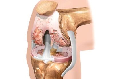 Pinsala sa magkasanib na arthrosis ng tuhod
