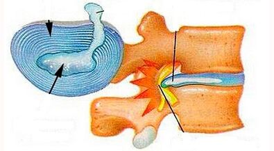 Mga tampok ng pagbuo ng cervical osteochondrosis