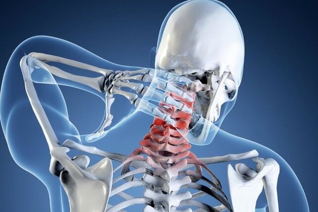 osteochondrosis ng cervical spine